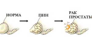 Чем опасна простатическая интраэпителиальная неоплазия?