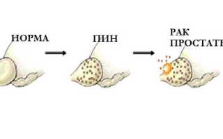 Чем опасна простатическая интраэпителиальная неоплазия?