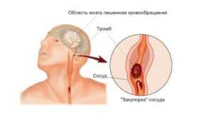 Диета после разных видов инсульта