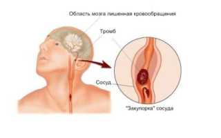 Диета после разных видов инсульта