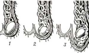 Проведение пробы Вальсальвы при варикоцеле