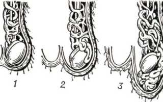 Проведение пробы Вальсальвы при варикоцеле