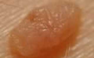 Папилломатозные невусы