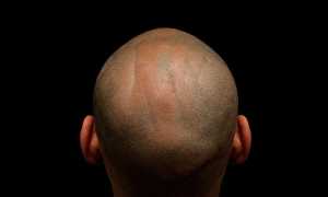 От чего могут выпадать волосы на голове?