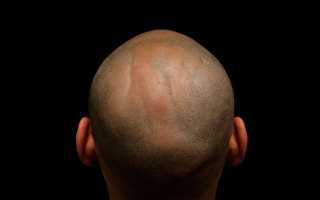 От чего могут выпадать волосы на голове?
