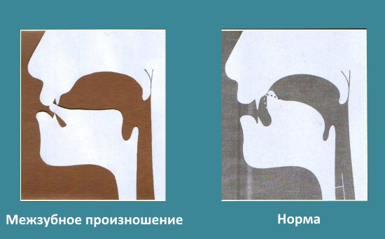 Межзубное произношение звука р и норма