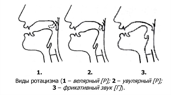 Виды ротацизма