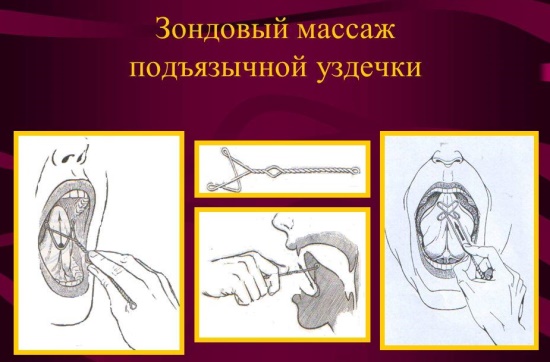 Массаж подъязычной уздечки при помощи зондов