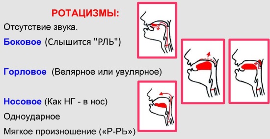 Виды ротацизма