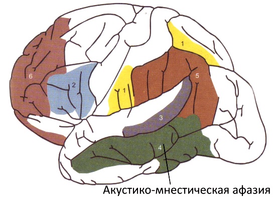 Зона поражения при акустико-мнестической афазии