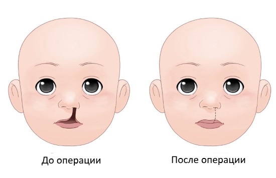 Расщелина верхней губы и неба, открытая врожденная ринолалия