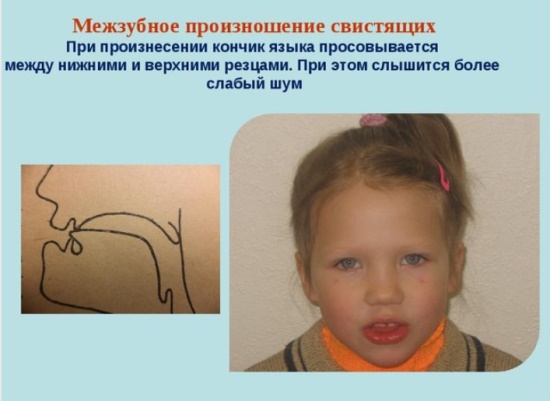 Межзубное произношение свистящих