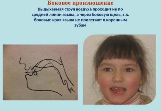Боковое произношение свистящих