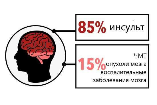 Этиология афазии