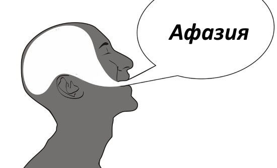 Постинсультная афазия