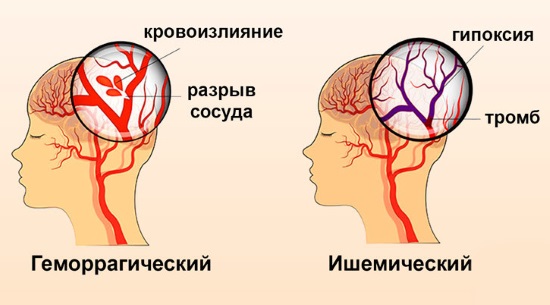 ОНМК по геморрагическому и ишемическому типу