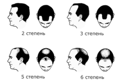 Степень облысения Степень облысения