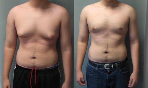 Гинекомастия