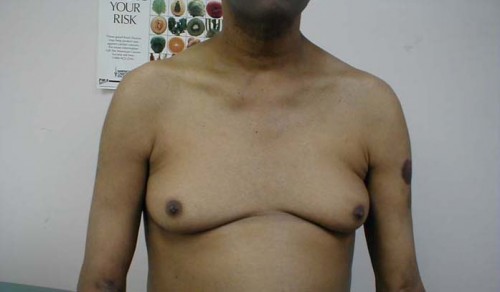 Гинекомастия у мужчин Гинекомастия у мужчин