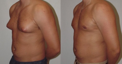 Гинекомастия