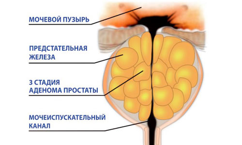 Аденома простаты третьей стадии Аденома простаты третьей стадии