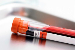 Анализ на герпес Анализ на герпес