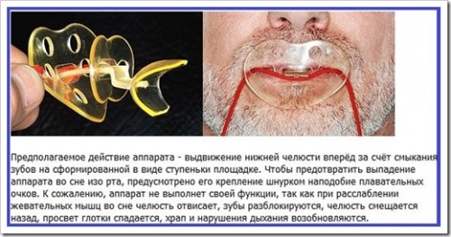 Аппарат от храпа Аппарат от храпа