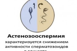 Астенозооспермия Астенозооспермия