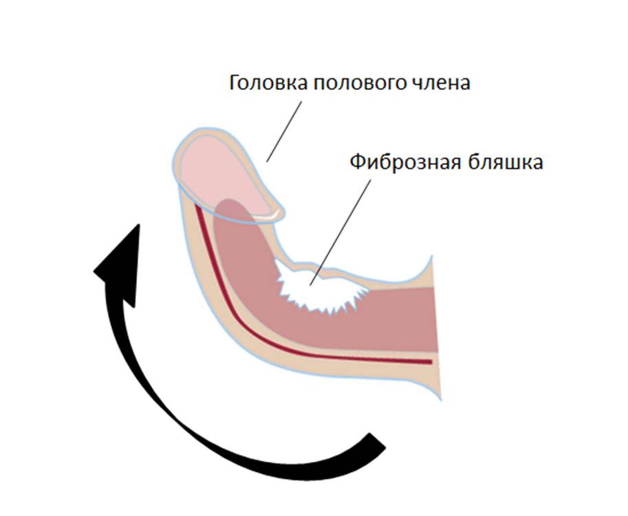 Болезнь Пейрони Болезнь Пейрони