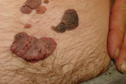 Вирус папилломы