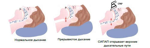 Действие аппарата Действие аппарата