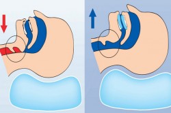 Действие капы Действие капы