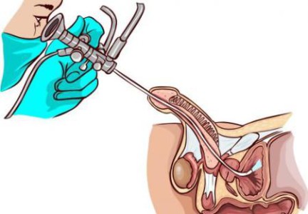 Диагностика уретрита Диагностика уретрита