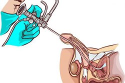 Диагностика варикоцеле Диагностика варикоцеле
