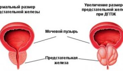 Доброкачественная гиперплазия простаты Доброкачественная гиперплазия простаты