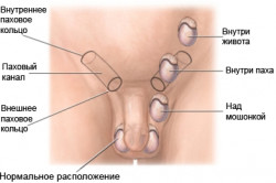 Факторы риска рака яичек Факторы риска рака яичек