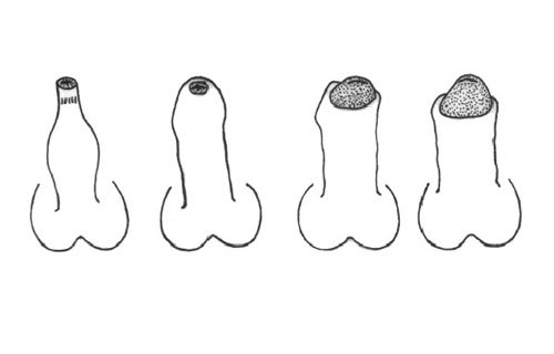 Схематичное изображение форм фимоза Схематичное изображение форм фимоза