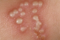 Генитальный герпес