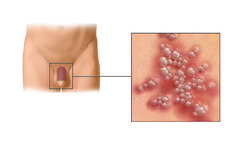 Генитальный герпес у мужчины Генитальный герпес у мужчины
