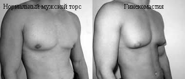 Гинекомастия у мужчин Гинекомастия у мужчин