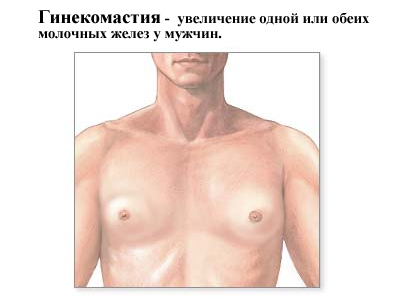 Гинекомастия у мужчины Гинекомастия у мужчины