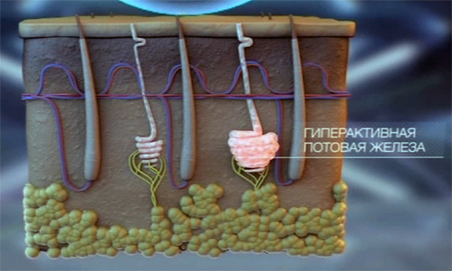 Гиперактивная потовая железа Гиперактивная потовая железа