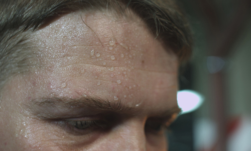 Гипергидроз лица Гипергидроз лица