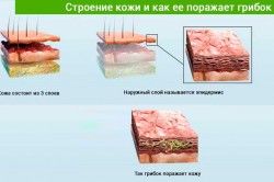 Грибок кожи Грибок кожи