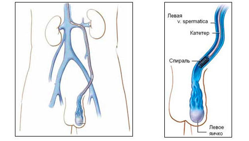 Хирургическое лечение варикоцеле Хирургическое лечение варикоцеле