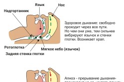 Храп и апноэ