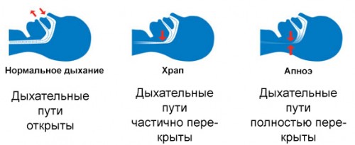 Храп и апноэ Храп и апноэ