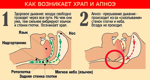Храп и апноэ Храп и апноэ