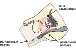 Ректальная методика лечения простатита Ректальная методика лечения простатита