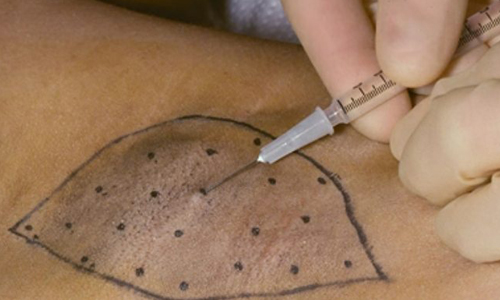 Инъекции ботокса при гипергидрозе Инъекции ботокса при гипергидрозе